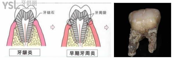 牙周袋變深