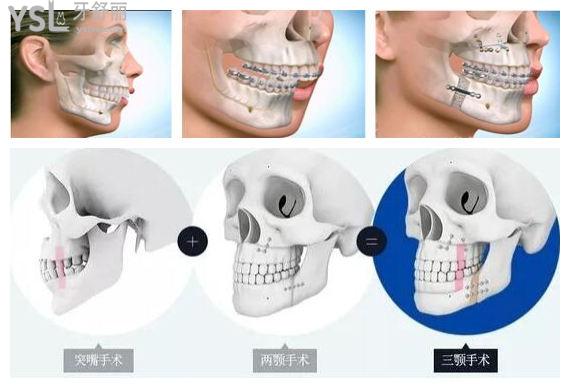 正頜手術(shù)前可以不正畸嗎 