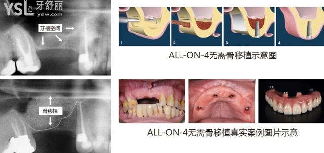 allon4即拔即種即刻負重