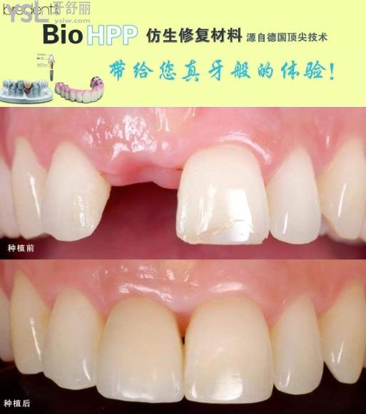 德國(guó)義齒品牌—hpp支架義齒的優(yōu)缺點(diǎn)和價(jià)格