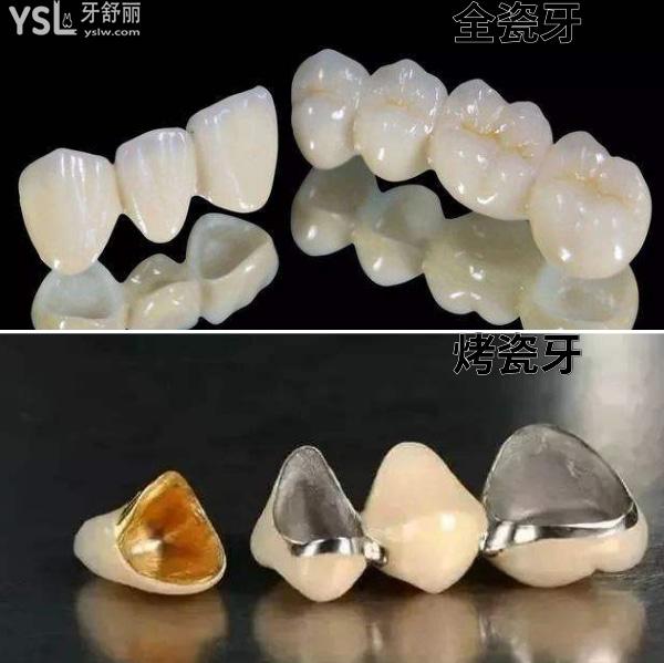 全瓷牙和烤瓷牙.jpg