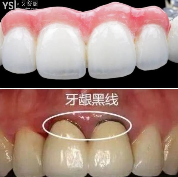 全瓷牙和烤瓷牙.jpg