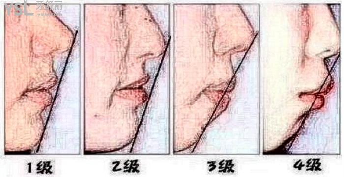 成年后骨性突嘴還能改善嗎？不想手術(shù)能戴牙套矯治不？不想手術(shù)看你能戴牙套矯治不！