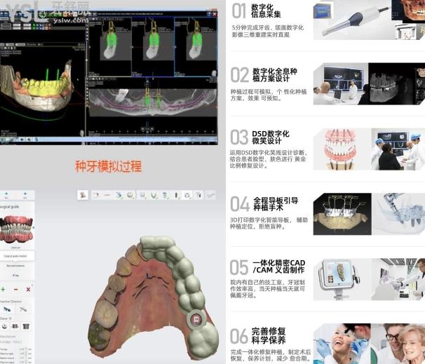 什么是3d數(shù)字化導板種植牙，3d數(shù)字化導板種植牙的作用和費用