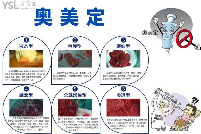 奧美定取出好的醫(yī)院有哪些