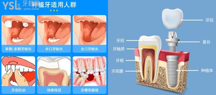 通州區(qū)看牙哪里好？盤(pán)一盤(pán)北京種植牙排名好的口腔醫(yī)院吧，反正離你也不遠(yuǎn)！