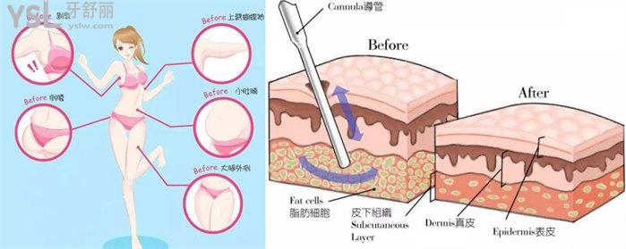 東莞十大吸脂實(shí)力排行榜 東莞吸脂醫(yī)生 抽脂價(jià)格