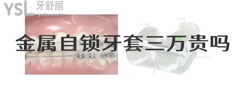 金屬自鎖牙套三萬