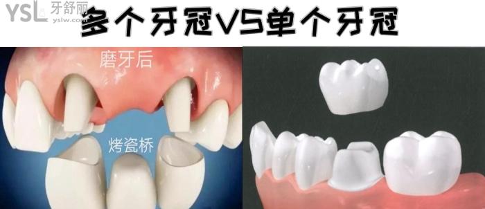 南京醫(yī)院可以做全瓷牙冠的有哪些？在南京烤瓷牙套一個多少錢呢？
