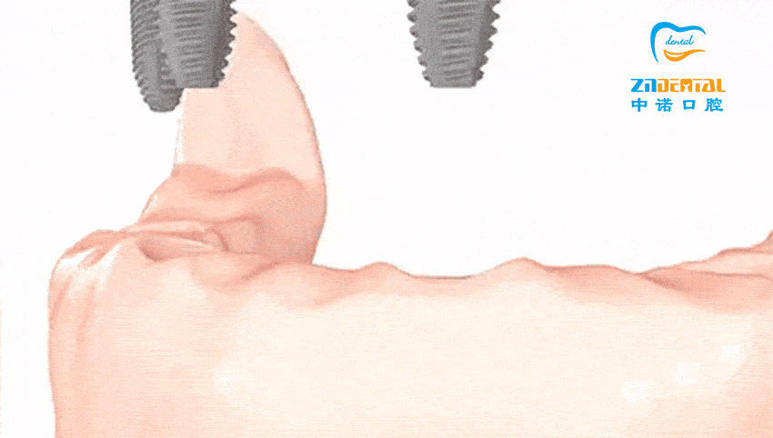 西安種植牙醫(yī)院實(shí)力排行，上榜前三的諾貝爾、中諾、團(tuán)圓口腔速看！