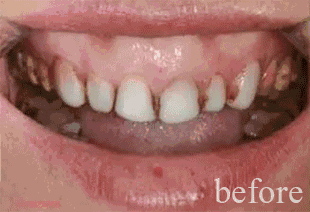 烤瓷牙整后.gif
