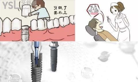瑞士牙齒種植體iti價(jià)格貴嗎