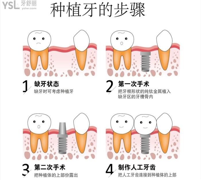 種植牙即刻負重真的能當天種當天用嗎?和不即刻負重種植體有區(qū)別嗎？