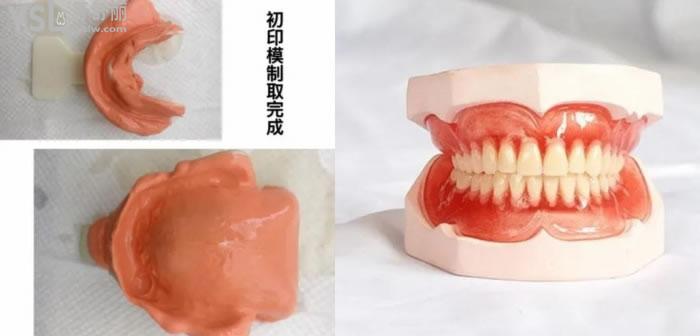 BPS義獲嘉半/全口吸附性義齒的優(yōu)缺點