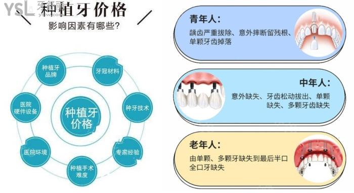 種植牙的價格差別為什么這么大？一顆種植牙2980元能靠譜嗎？