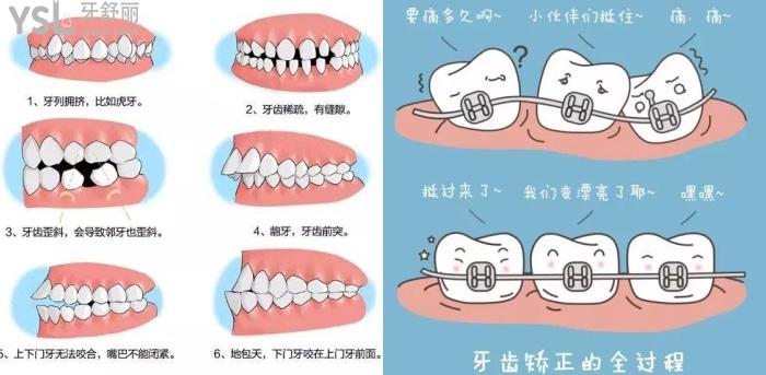 牙齒矯正的難度分級(jí)標(biāo)準(zhǔn)是什么？重度牙齒畸形可以用隱形牙套嗎？