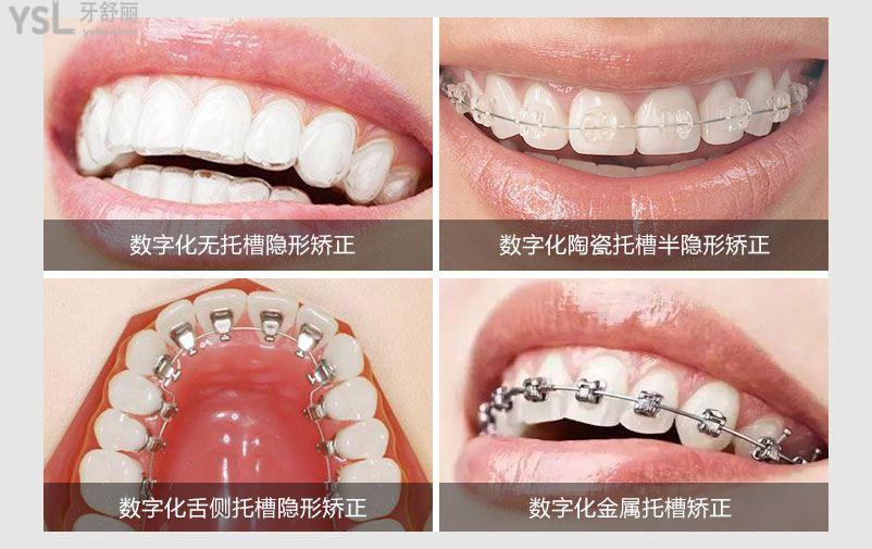 牙齒矯正的難度分級(jí)標(biāo)準(zhǔn)是什么？重度牙齒畸形可以用隱形牙套嗎？