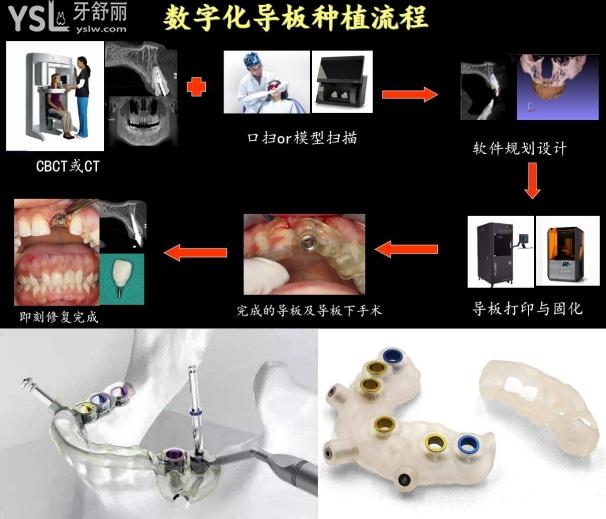 3d數(shù)字化導板種植牙是什么