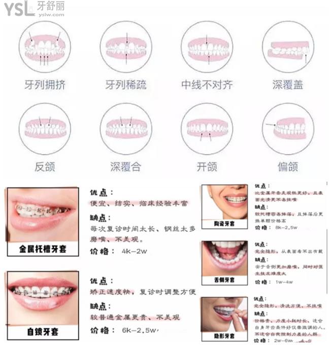 各矯正器優(yōu)勢