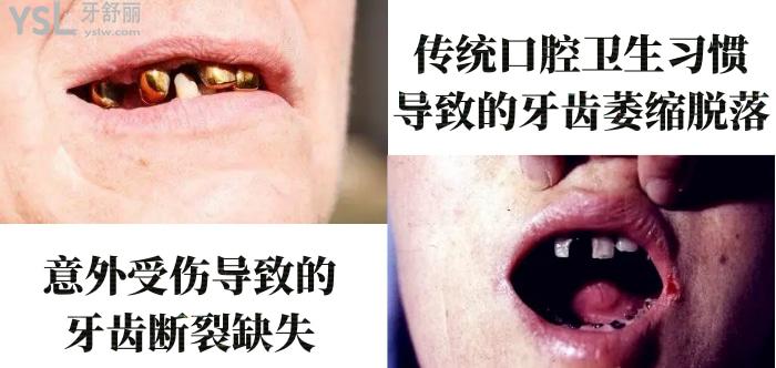 50歲做種植牙心酸歷程！種植牙6年后的真實感受100字親歷！