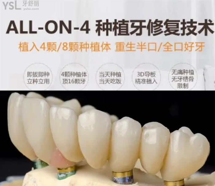 50歲做種植牙心酸歷程！種植牙6年后的真實感受100字親歷！