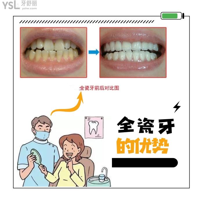 格萊美全瓷牙是進(jìn)口的還是國產(chǎn)的