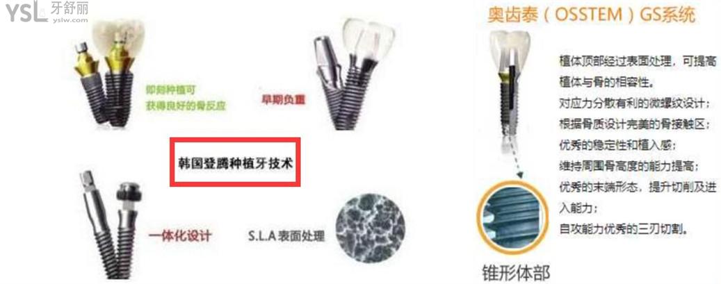 韓國種植牙品牌怎么樣