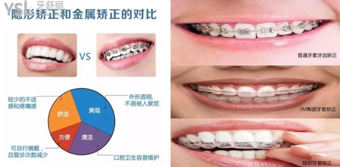 牙齒矯正對比