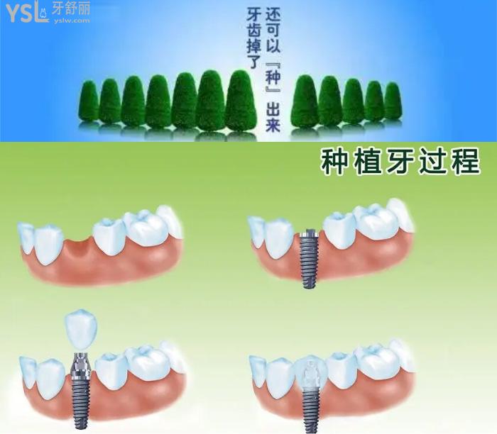 廣州種植牙哪個(gè)醫(yī)院做的好?這些有名的種植牙醫(yī)生價(jià)格公道口碑好不可錯(cuò)過!