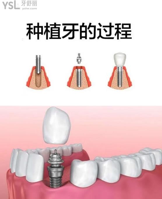單顆種植牙圖