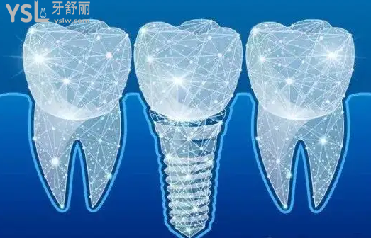 種植牙納入醫(yī)療保險(xiǎn)進(jìn)展！2022種植牙醫(yī)改及集采政策！