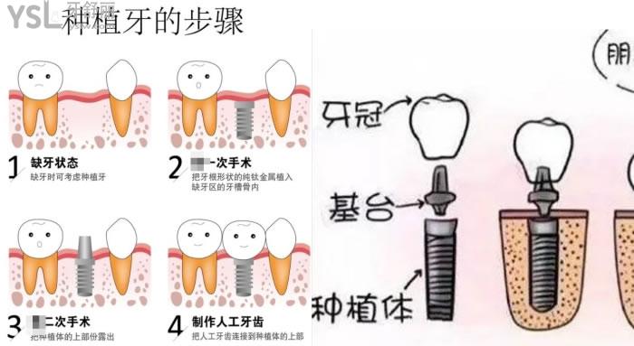 種植牙納入社保后可以省多少錢