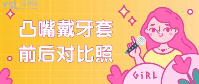 凸嘴戴牙套前后對比照