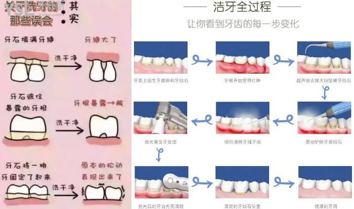 潔牙的操作流程及注意事項(xiàng)