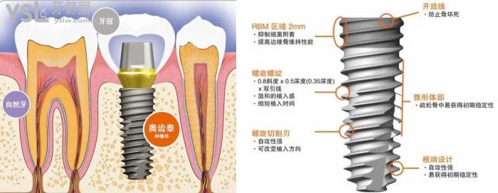 奧齒泰種植體型號(hào)圖譜詳細(xì)介紹