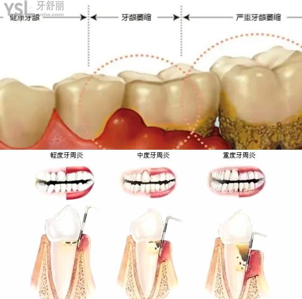 種植骨粉需要多久可以變成骨頭.jpg