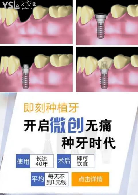 種植牙圖