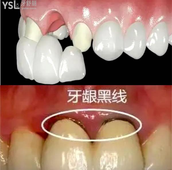 西安地區(qū)全瓷牙套一顆多少錢.jpg