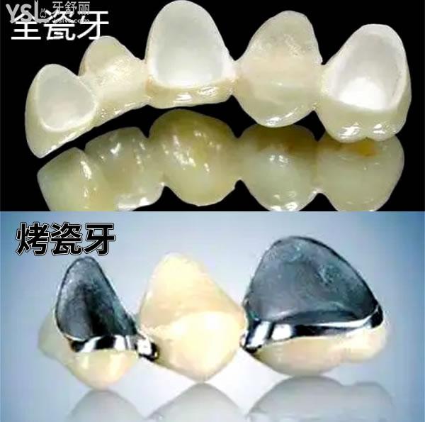 西安地區(qū)全瓷牙套一顆多少錢.jpg