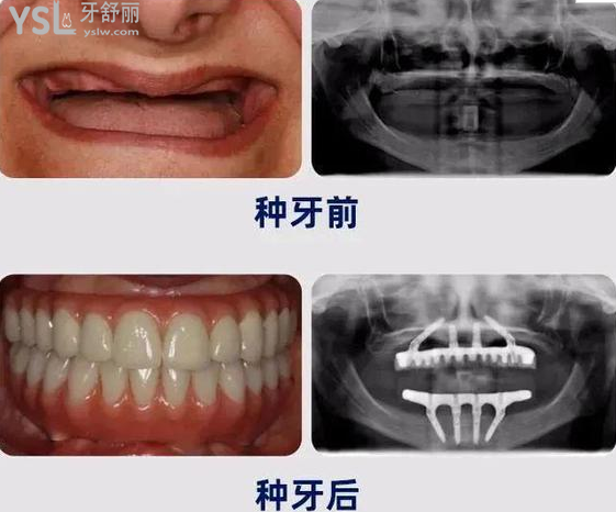 請把這條大數(shù)據(jù)推給缺牙的人，福州維樂口腔醫(yī)院幫助缺牙人士重拾口福！