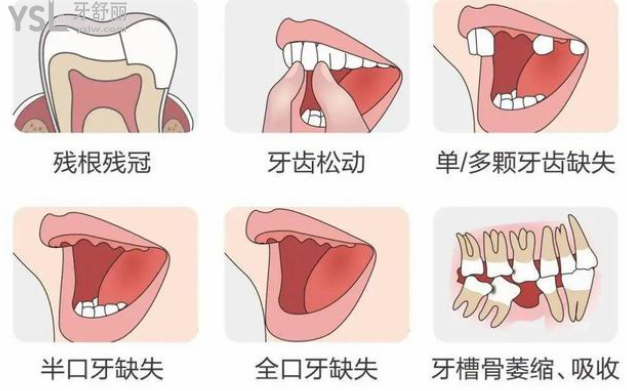 今年比較火的種植牙**，鄭州植得口腔醫(yī)院響應(yīng)號召了！吹爆了！