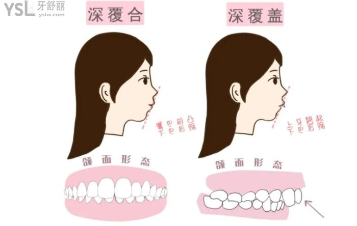 深覆合和深覆蓋圖例