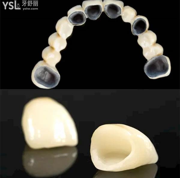 西安烤瓷牙的價格一顆多少錢.jpg