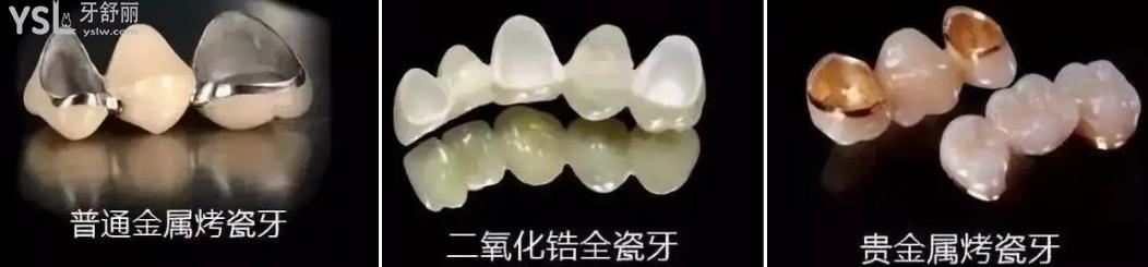 全瓷牙烤瓷牙.jpg