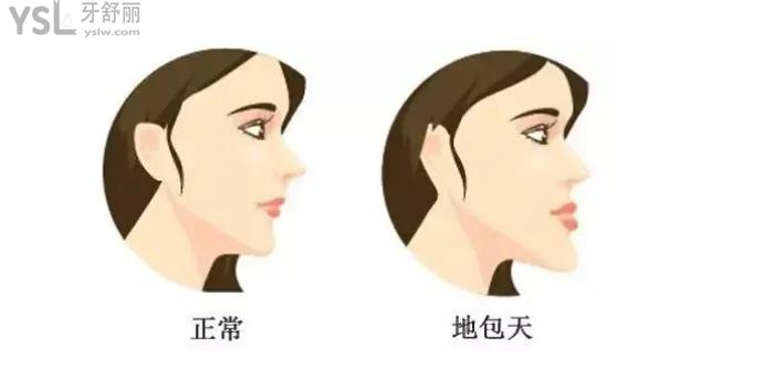 地包天側(cè)臉對比