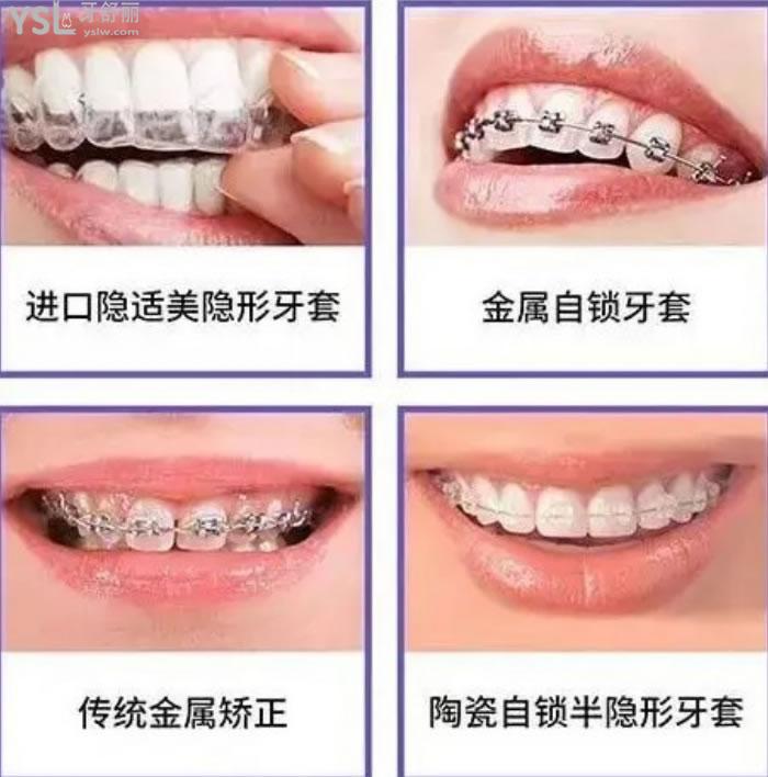 合肥隱形牙套價格