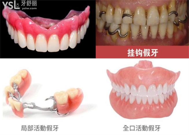 吸附性義齒和普通假牙有啥區(qū)別