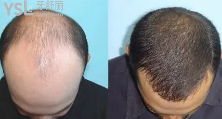 衡陽雅美父親節(jié)有植發(fā)活動(dòng)，送父親禮物不如帶父親去植發(fā)，讓父親年輕持久