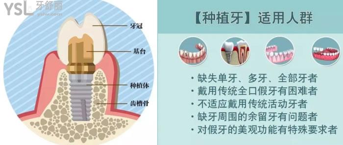 無(wú)錫種植牙多少錢(qián)一顆