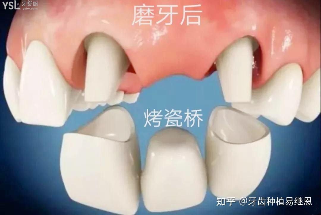烤瓷牙